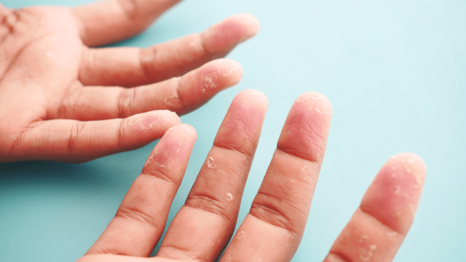 Desidrose - causas, prevença e tratamento clinica awada dermatologista santo andre abc