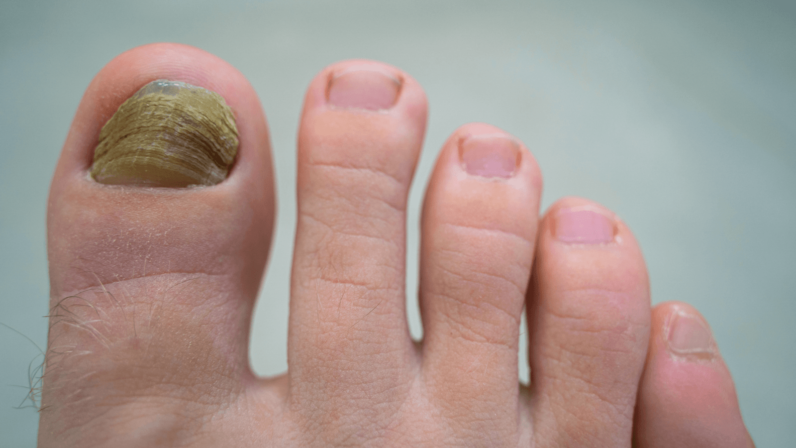 Micose de Unha Clínica Awada Dermatologia Santo André