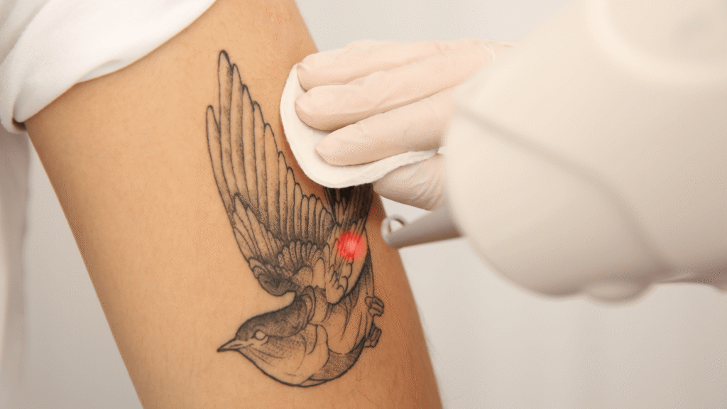 Remoção de Tatuagem clinica awada santo andre acb dermatologista
