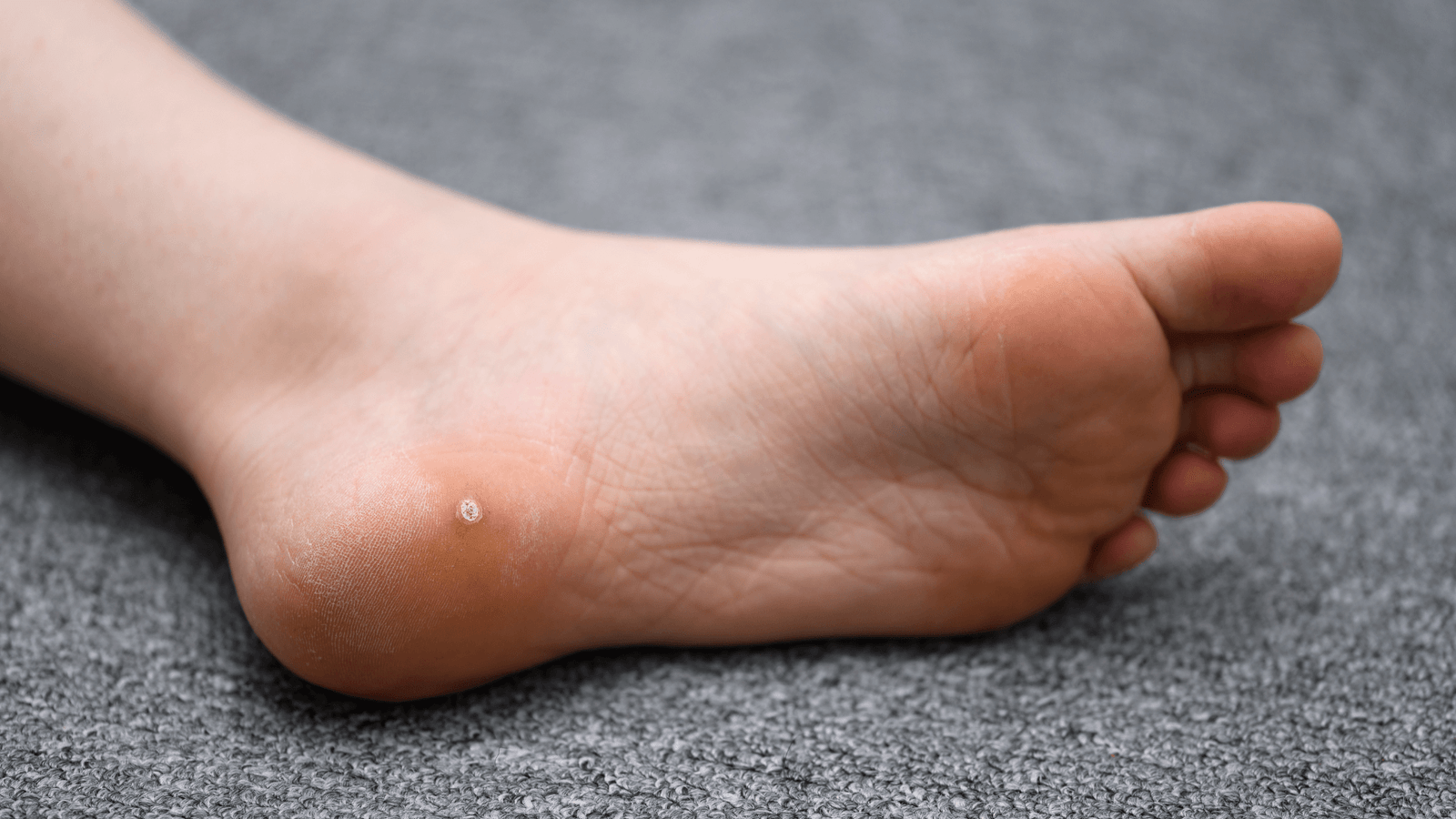 Olho de Peixe Verruga Plantar o que é como tratar na clinica awada dermatologia santo andré