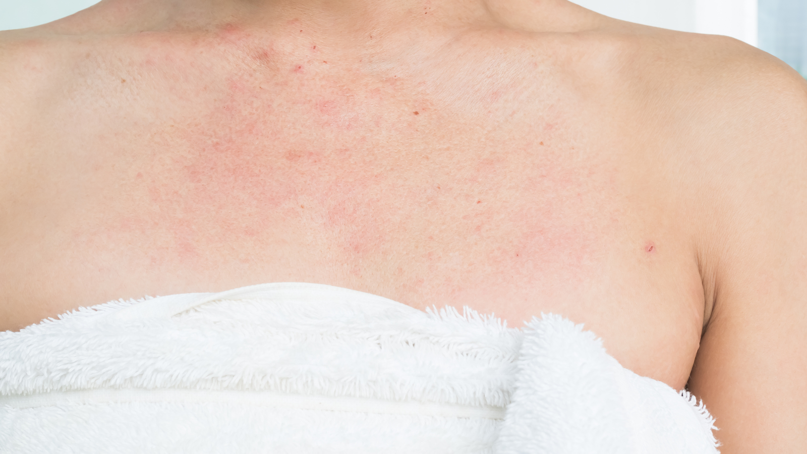 Urticária: entenda causas, sintomas e tratamento dermatológico especializado