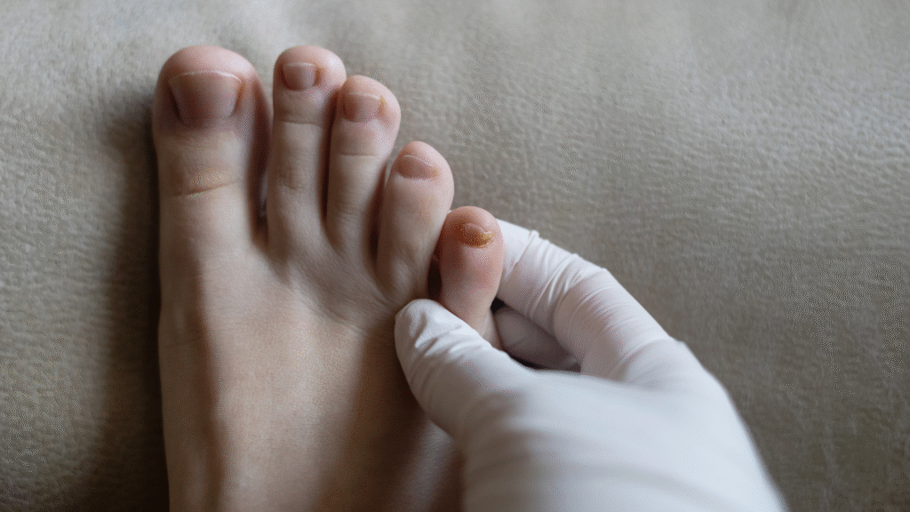 Unha amarelada e espessada com sinais de micose