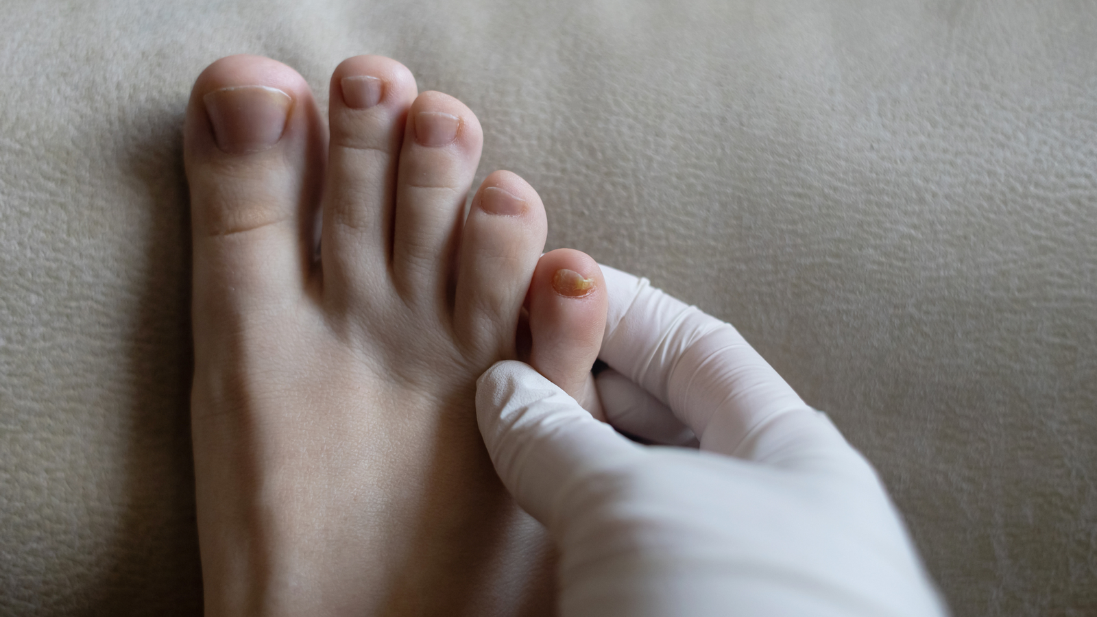 Unha amarelada e espessada com sinais de micose