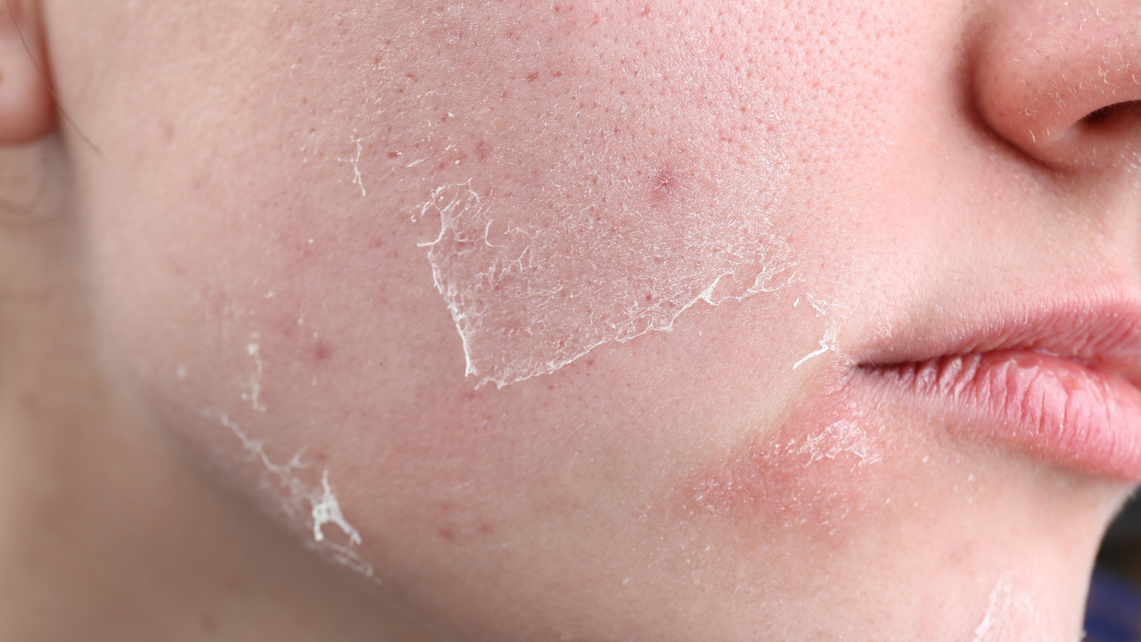 Manchas avermelhadas na pele com aspecto circular típico de infecção fúngica