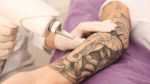 Aplicação de laser em tatuagem no braço para remoção gradual do pigmento
